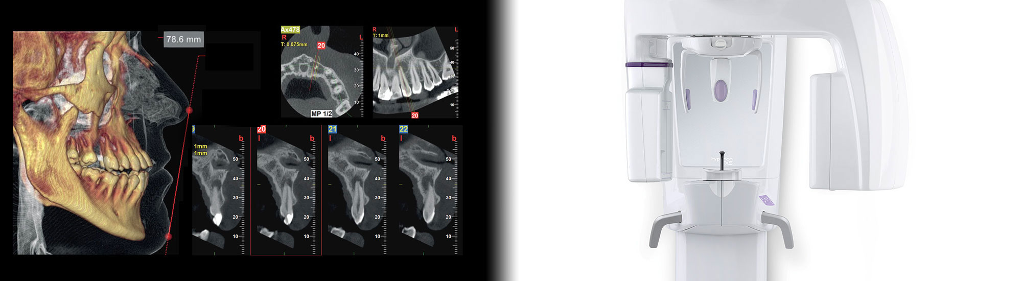 3D-Röntgen-DVT